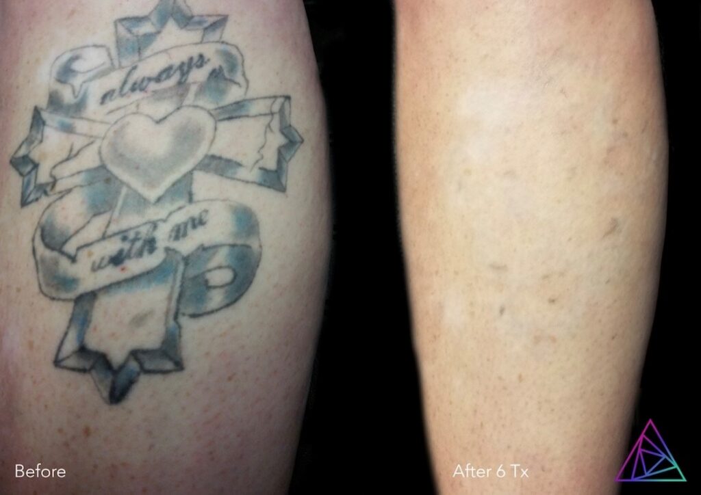 Before & After Results Rethink Tattoo Removal in Rochester NY