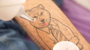 Client receiving laser tattoo removal treatment on their arm, showing the procedure in action