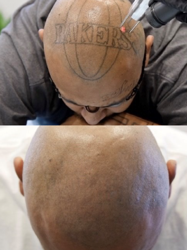 Before and after laser tattoo removal of a black Lakers scalp tattoo