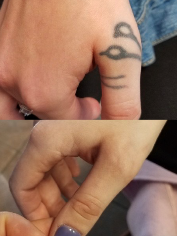 Before and after laser tattoo removal of a small black finger tattoo