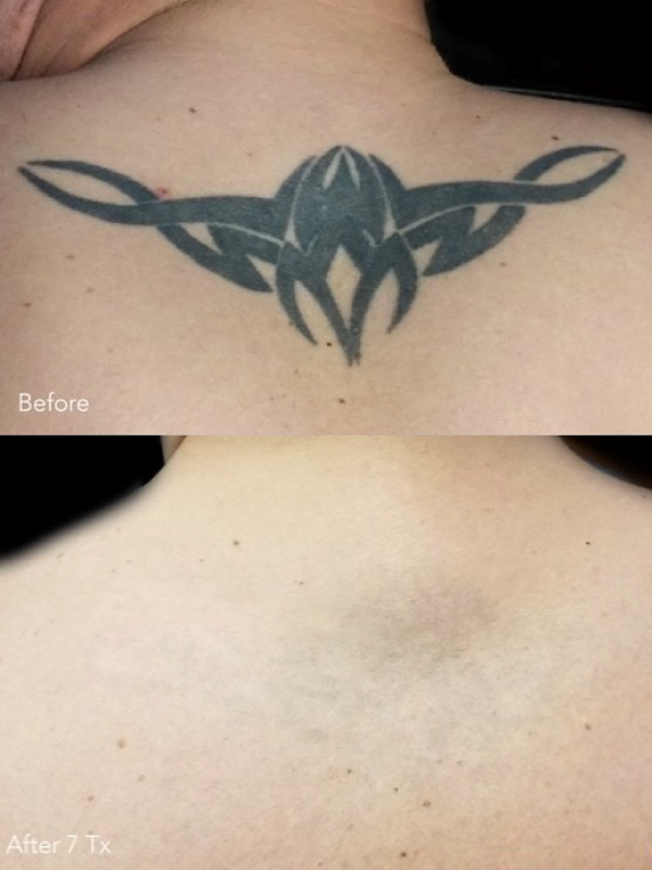 Before and after laser tattoo removal of a large black upper-back tattoo after seven treatments
