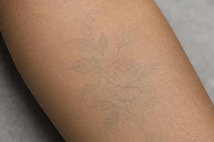 Close-up of an arm with a very faint, faded tattoo.