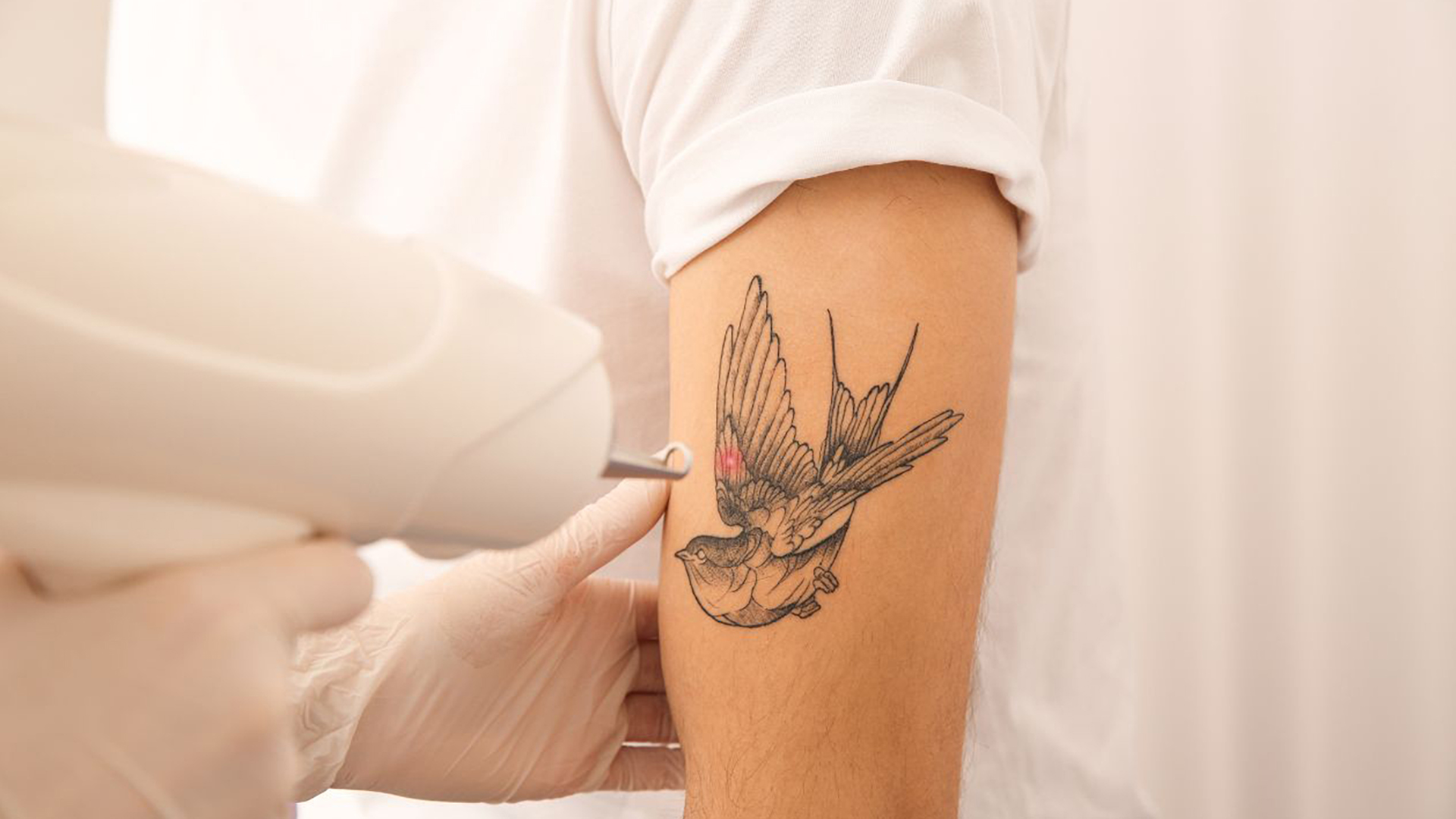 Laser device treating a tattoo on a client's skin during a removal session