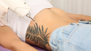 Gloved technician using a laser device to treat a black tribal-style tattoo on a client's hip