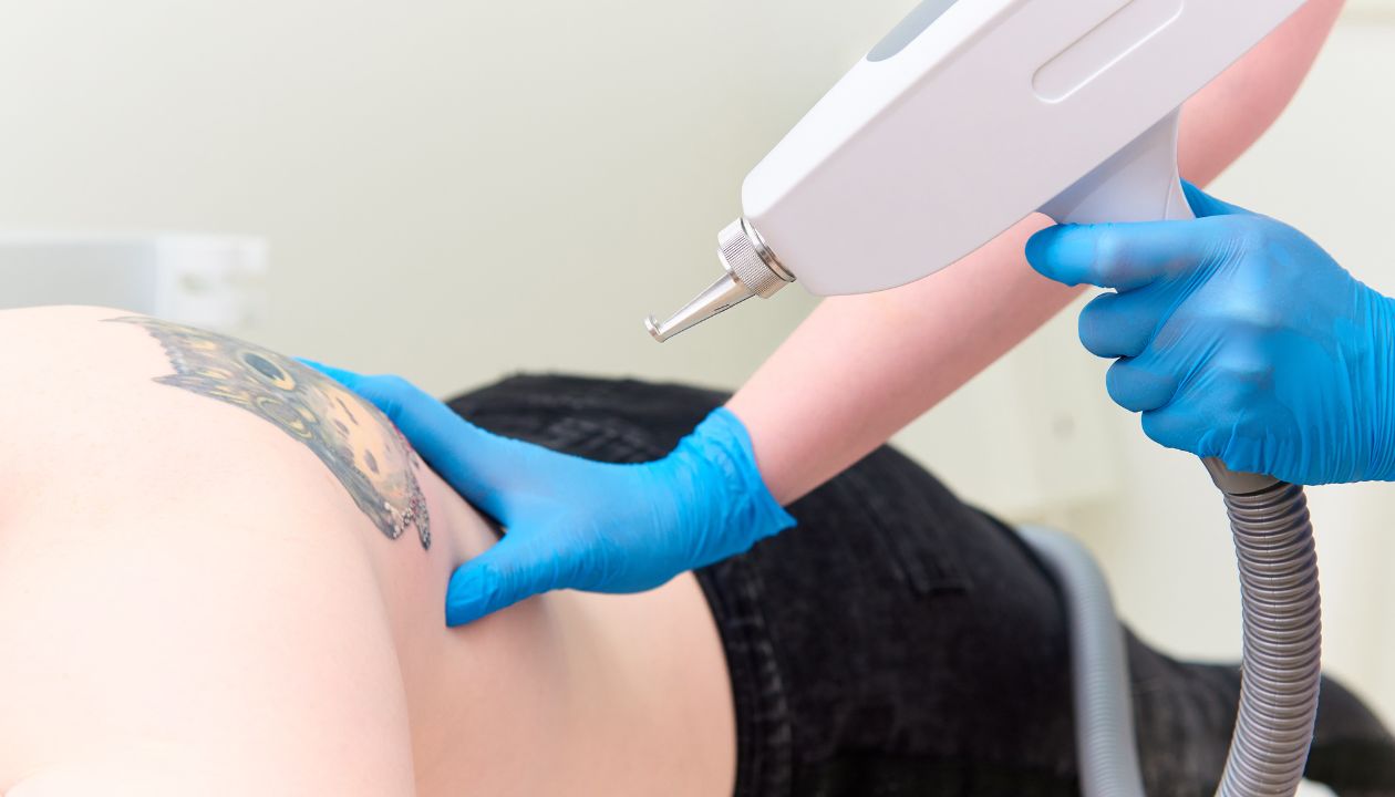 Gloved technician holding a laser device over a butterfly tattoo on a client's shoulder blade