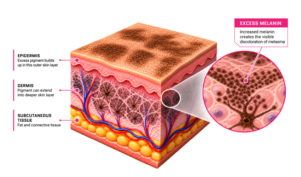 Melasma Pigmentation in the Skin